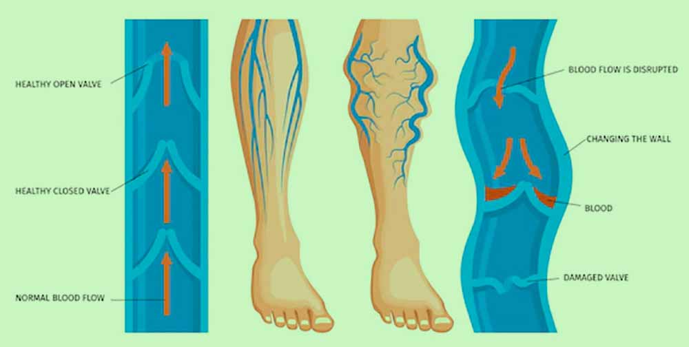 venous_bolezen